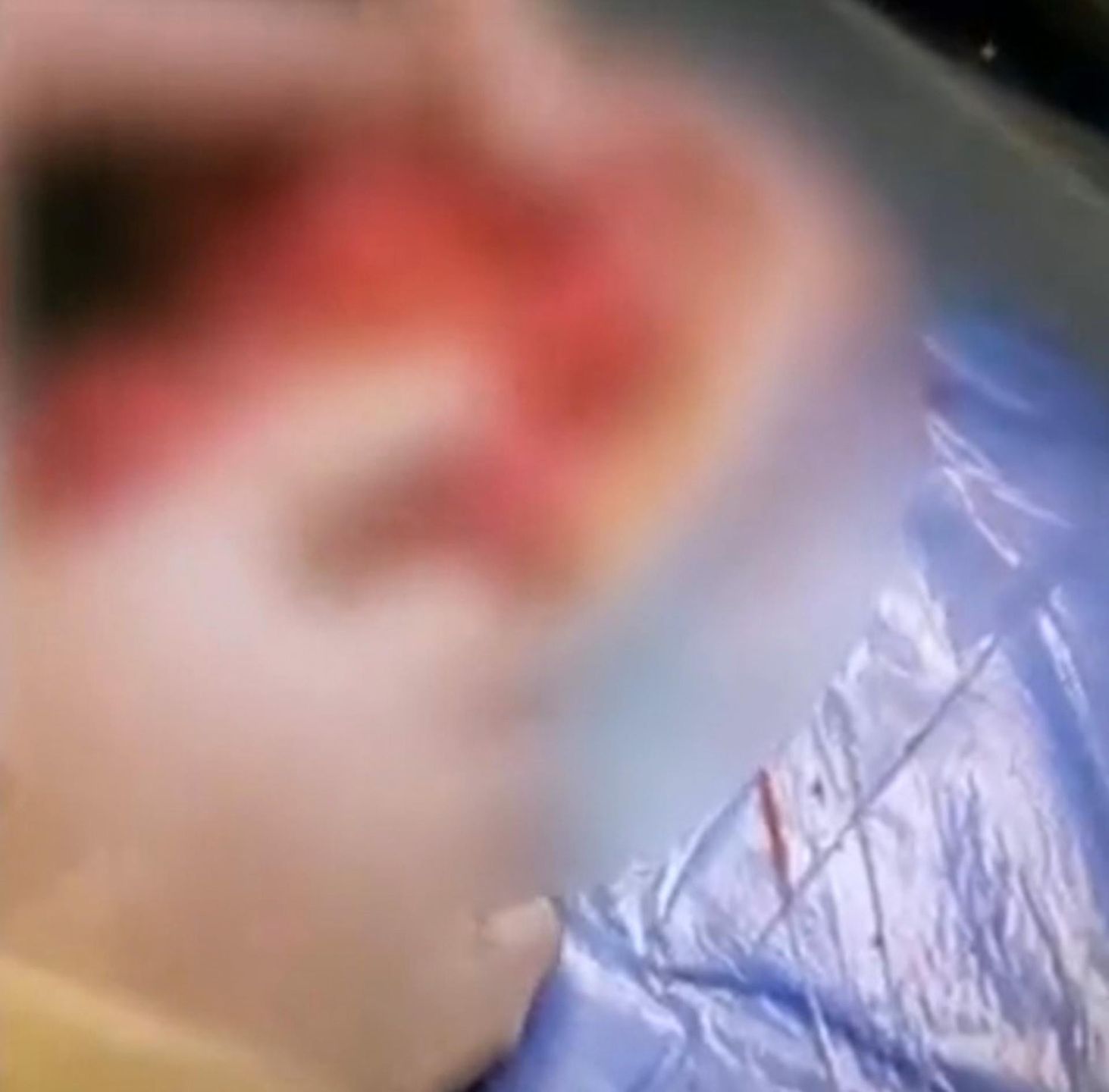 Koraliki przedziurawiły chłopcu  jelita