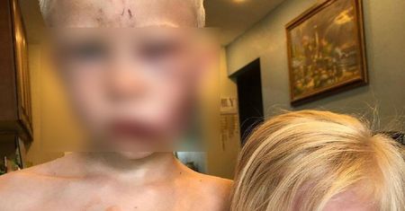 6-latek uratował swoją siostrę przed atakiem psa. Założono mu 90 szwów