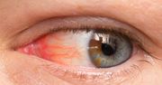 Czerwone oko – przyczyny, leczenie