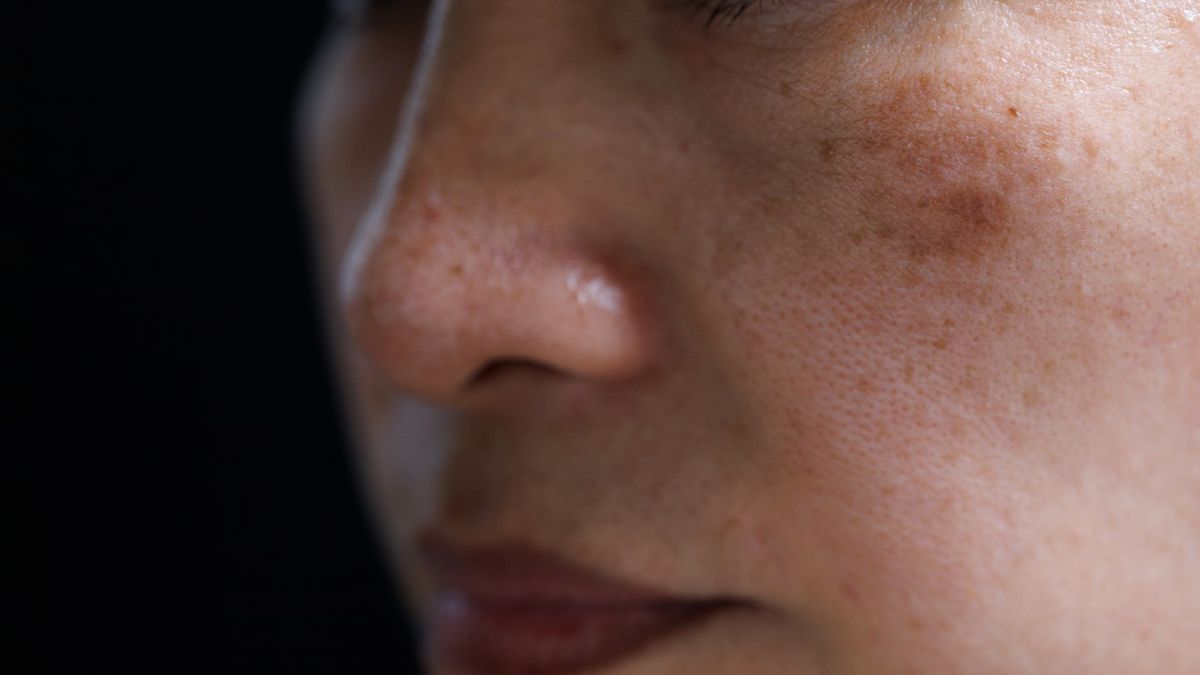 Najskuteczniejszym sposobem walki z przebarwieniami są zwykle inhibitory tyrozynazy.