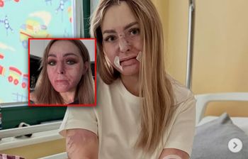 Miała tylko 20 procent szans na przeżycie. Influencerka przeszła kolejną operację