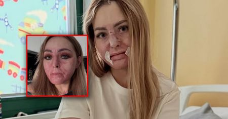 Miała tylko 20 procent szans na przeżycie. Influencerka przeszła kolejną operację