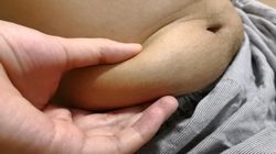 Pojawia się u osób z nadwagą. Może zwiększać ryzyko raka wątroby