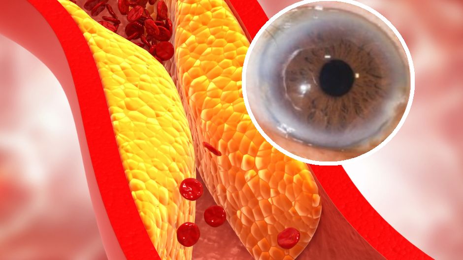 Tak może objawiać się wysokie stężenie cholesterolu