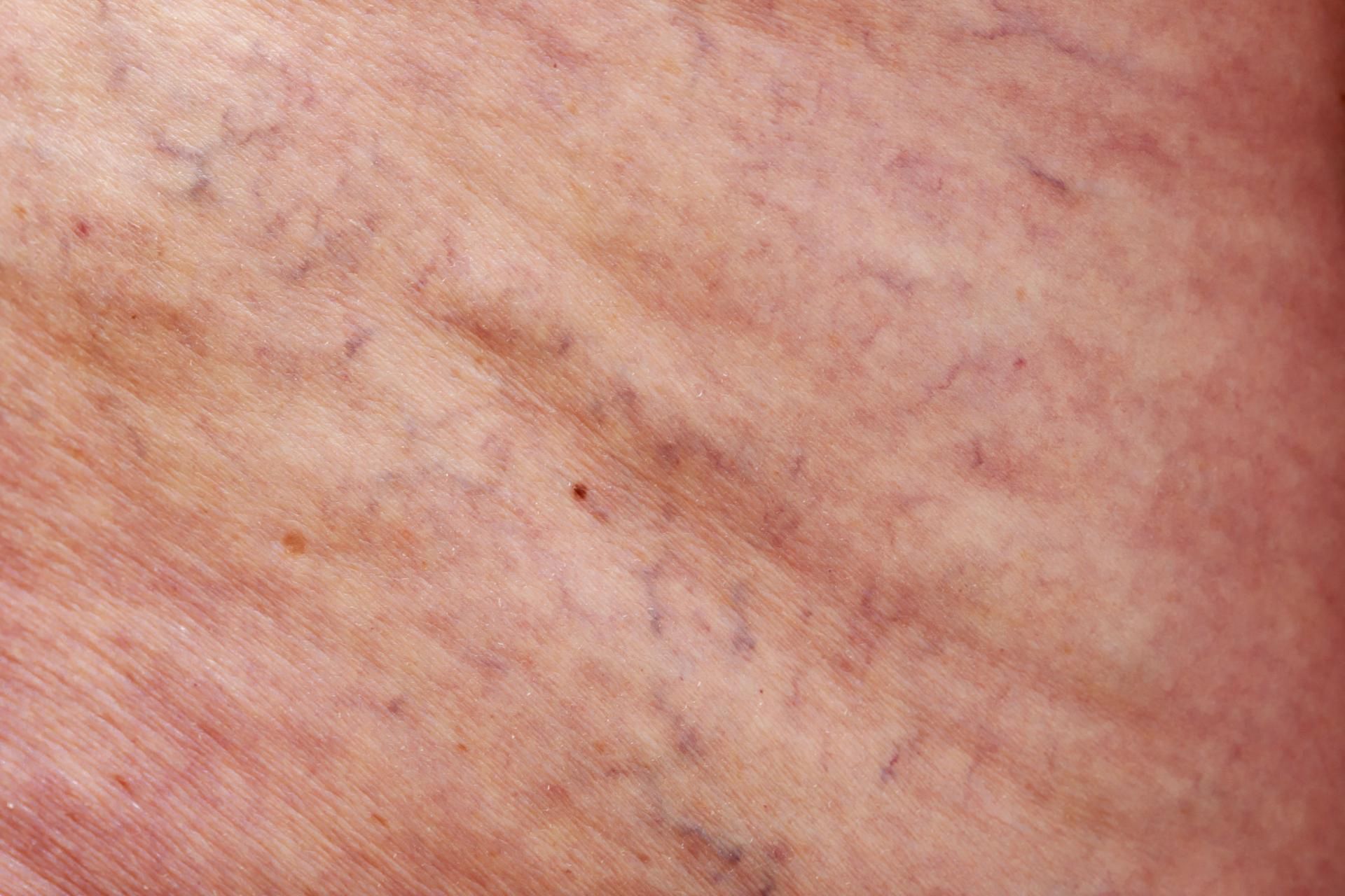 Zakażeni koronawirusem są narażeni na powikłania zatorowo-zakrzepowe