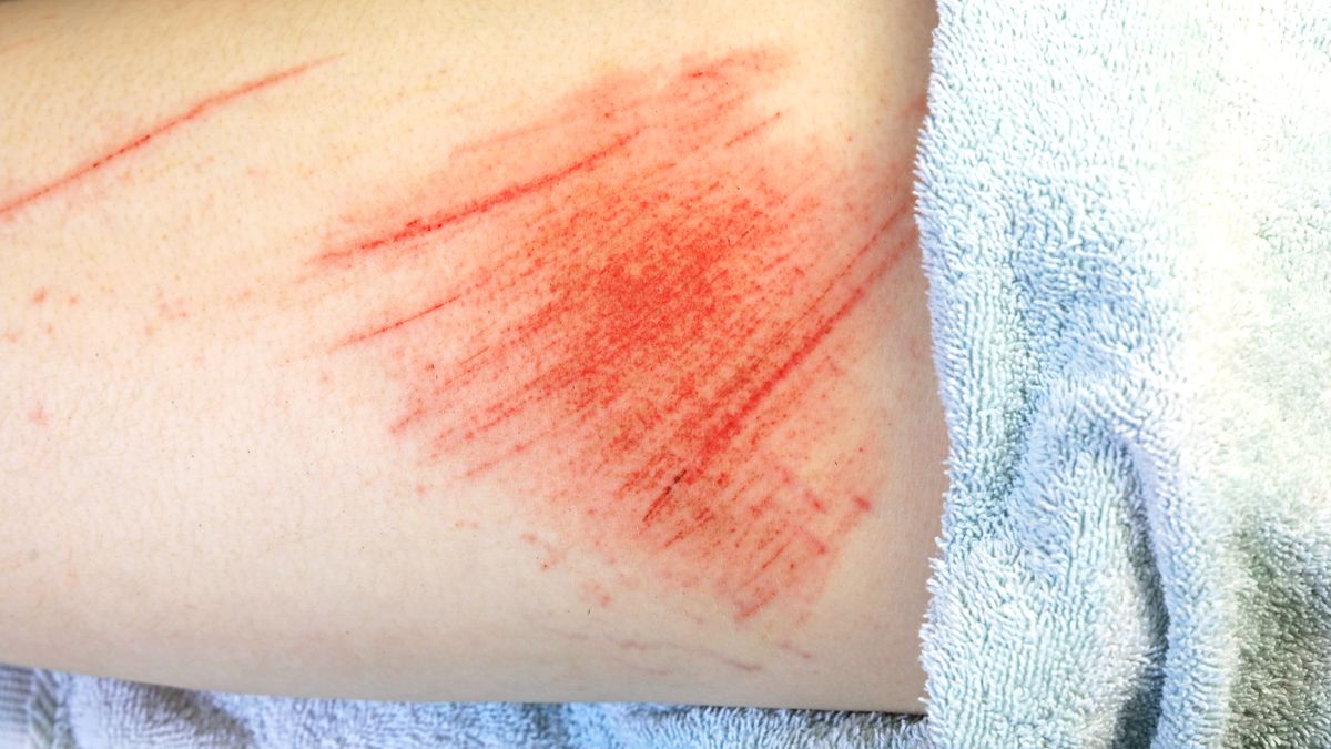 Otarcia to powierzchniowe uszkodzenie skóry powstałe w wyniku kontaktu z szorstką powierzchnią.