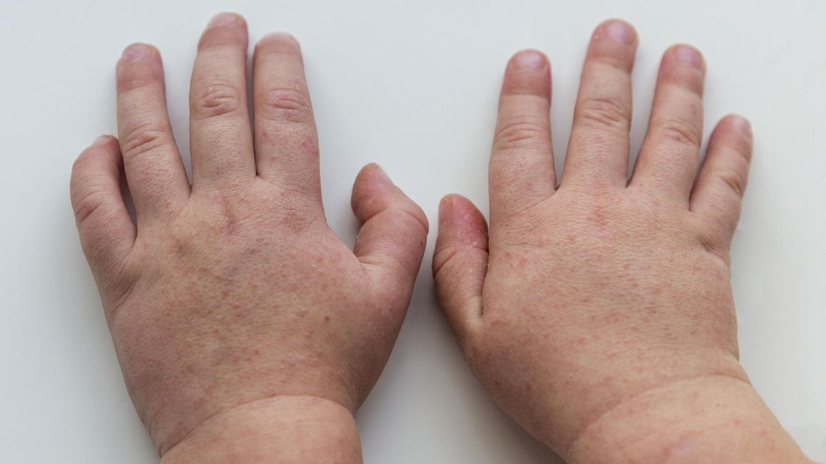 Pierwsze objawy szkarlatyny u dzieci zaczynają się około 3 dni po kontakcie z chorą osobą