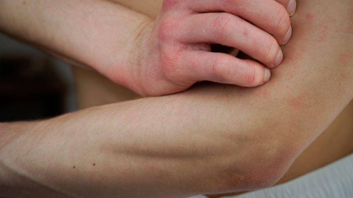 Suchość skóry sprawia, że ta jest bardziej wrażliwa na czynniki środowiskowe