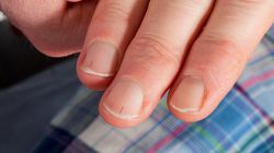 Nietypowy objaw choroby serca. Pojawia się na paznokciach