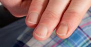 Nietypowy objaw choroby serca. Pojawia się na paznokciach