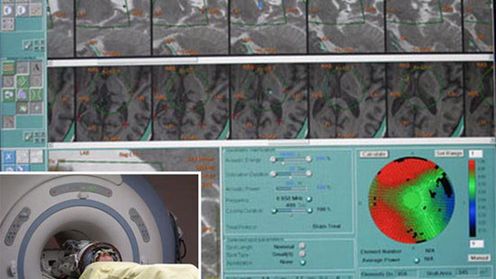 Neurochirurgia z wykorzystaniem fal dźwiękowych 1