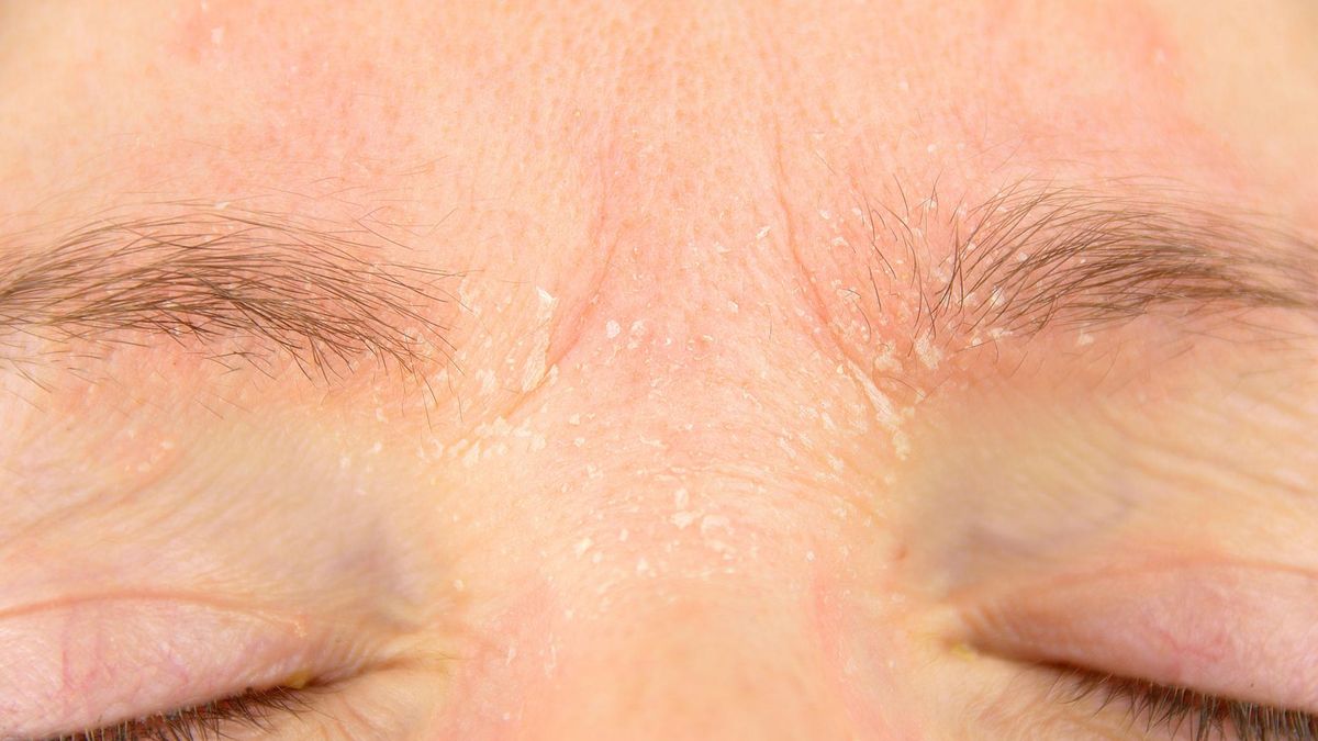 produkty, które nasilają objawy egzemy [123rf.com]