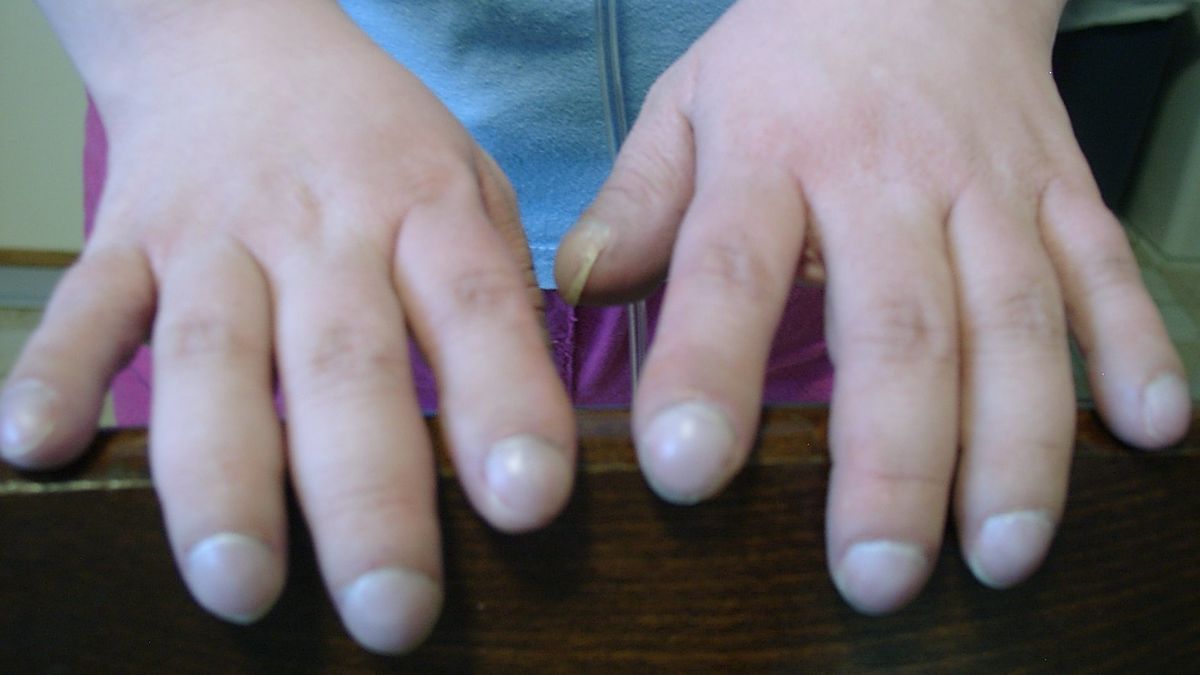  Paznokcie te w specyficzny sposób zawijają się, jest to najlepiej widoczne z boku. Końce palców mogą się powiększać i zmieniać kształt.