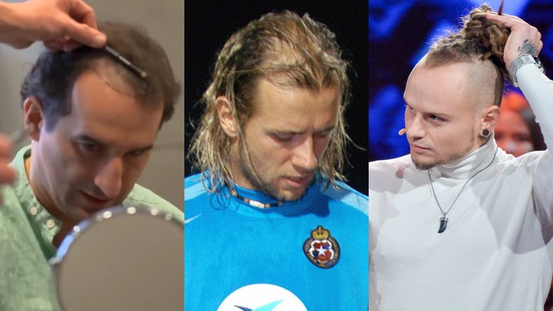 Oni zdecydowali się na przeszczep włosów. Lista jest długa