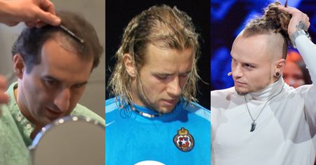 Oto gwiazdy, które zdecydowały się na przeszczep włosów. Radosław Majdan, Michał Koterski czy Qczaj to dopiero początek listy (ZDJĘCIA)