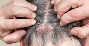 Swędząca skóra głowy. 5 nieoczywistych przyczyn problemu
