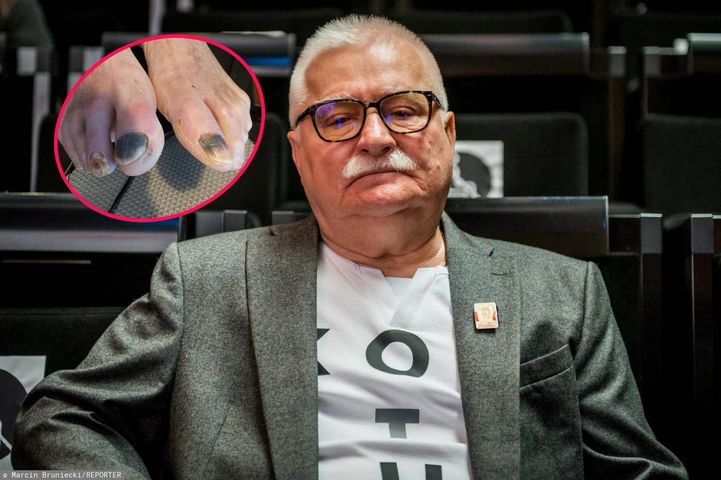 Lech Wałęsa pokazał stopy. Oto efekt stopy cukrzycowej