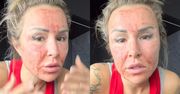 Blanka Lipińska pokazała zakrwawioną twarz po zabiegu: "To jest taki poranek, kiedy nie chcesz się obudzić przy mnie" (FOTO)