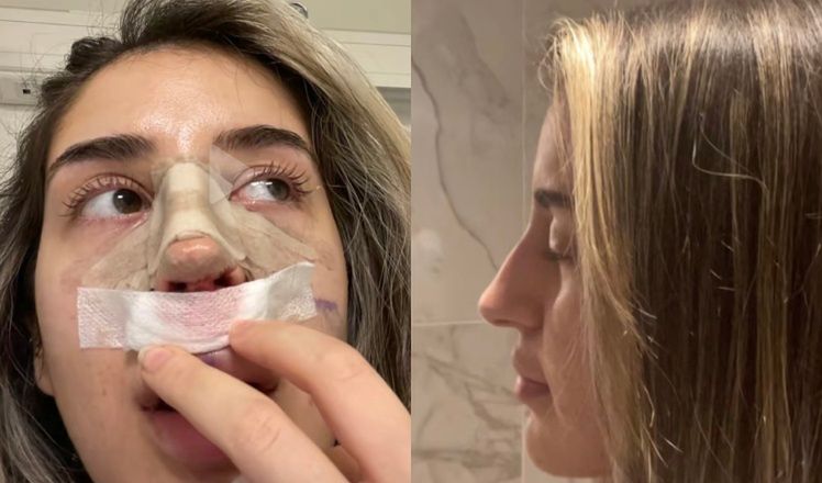 Tiktokerka poleciała do Turcji zoperować sobie nos: "Obudziła się zlana potem i pokryta bandażami" (FOTO)