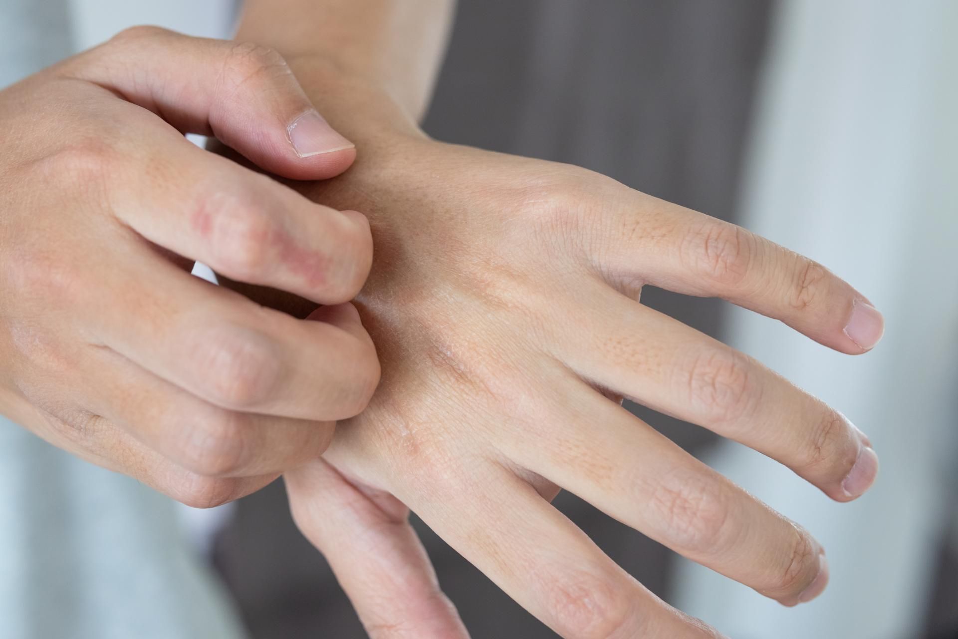 Świąd skóry może alarmować o nowotworze