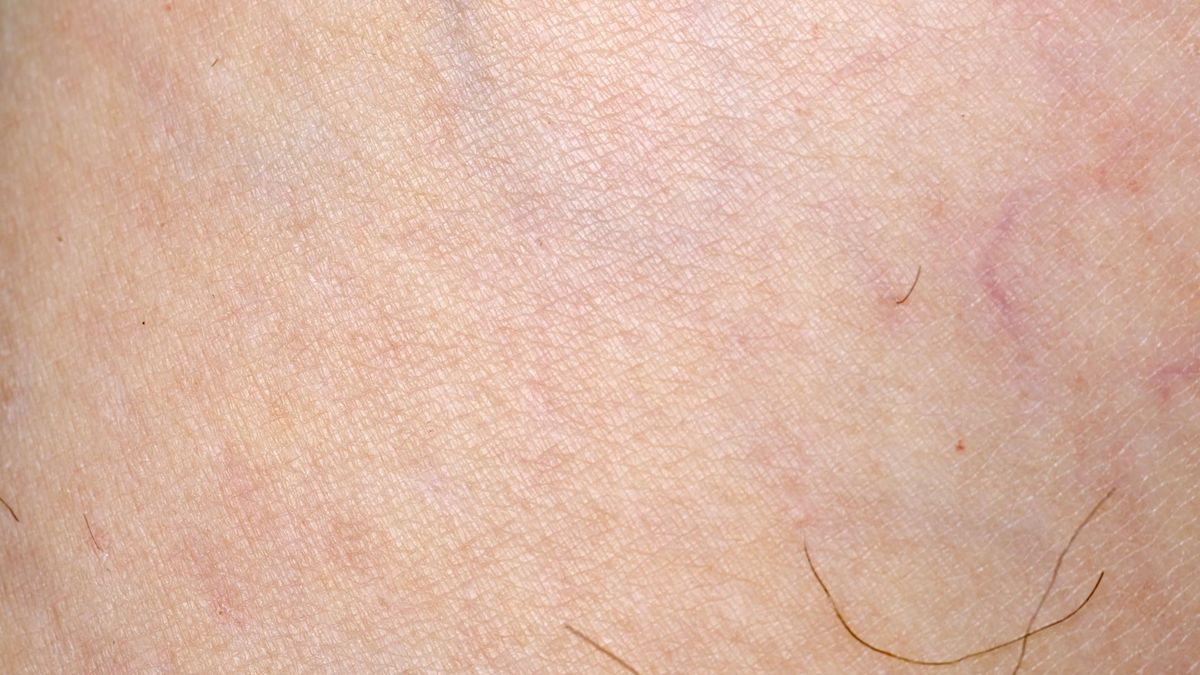 Teleangiektazje, inaczej pajączki naczyniowe mogą pojawić się u osób w różnym wieku.