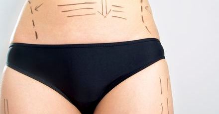 Bridalplasty - kolejna przedślubna obsesja?