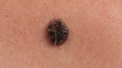 Rak skóry - charakterystyka, przyczyny, objawy, leczenie