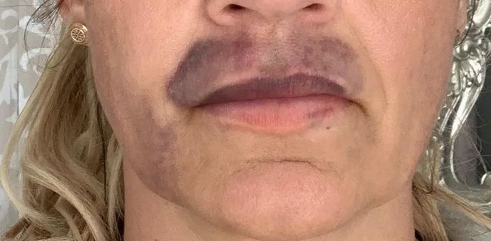 Kobieta ostrzega innych przed zabiegami medycyny estetycznej w niesprawdzonych firmach
