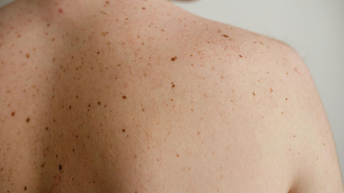 Rak skóry groźny latem. Jego symptomem jest… chropowata skóra