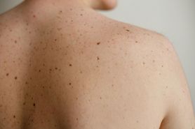 Rak skóry groźny latem. Jego symptomem jest… chropowata skóra