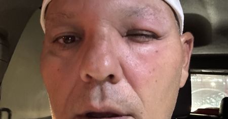 To nie jest przymknięte oko. Padł ofiarą ataku owada