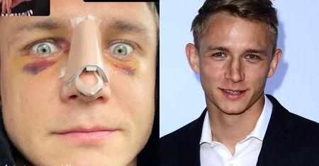 Jakub Rzeźniczak przyznał się do DWÓCH operacji nosa. Pokazał zdjęcia "przed" i "po". Robi wrażenie?