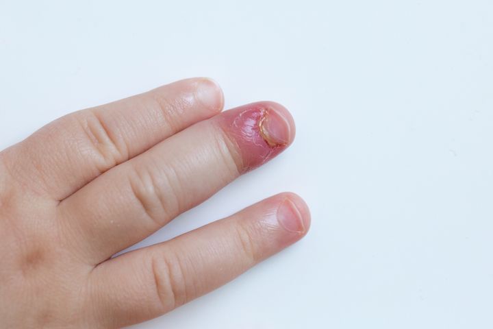Zastrzał palca może być wynikiem obgryzania paznokci