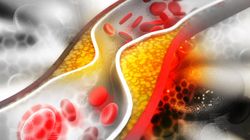 Nietypowe objawy miażdżycy. Kardiolog ostrzega