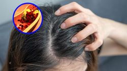 Objaw zauważysz na głowie. Znak, że cholesterol zapycha tętnice