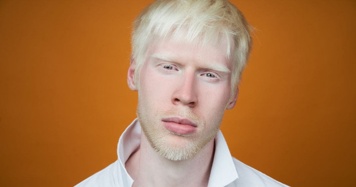 Albino Models Who Have Changed the Fashion Industry - MyImpact