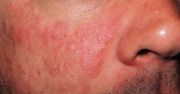 Pierwszy objaw może pojawić się na nosie. Choroba uszkadza nerki, stawy czy mózg