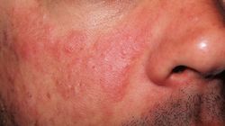 Pierwszy objaw może pojawić się na nosie. Choroba uszkadza nerki, stawy czy mózg