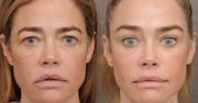 Denise Richards przeszła lifting twarzy. Lekarz pokazał efekt przemiany 55-latki. Robi wrażenie? (ZDJĘCIA)