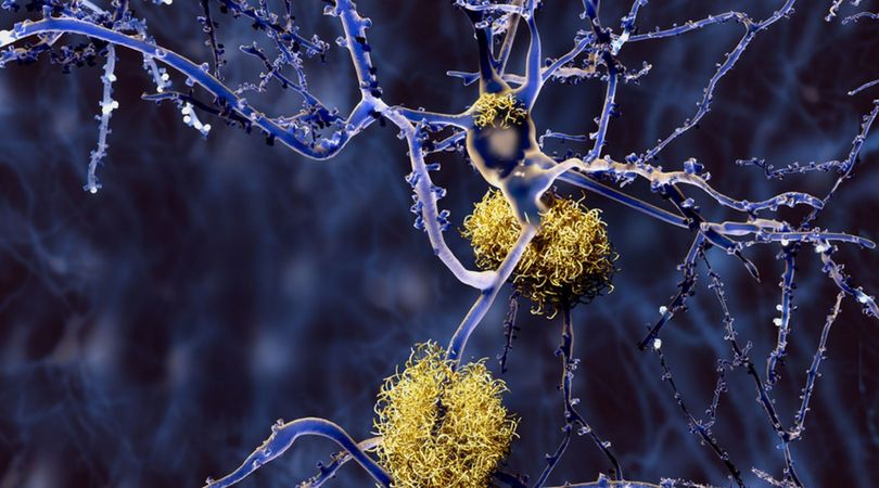 Rozwijająca się choroba Alzheimera