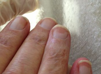 Nie lekceważ tych zmian. Paznokcie mogą ujawniać poważne choroby