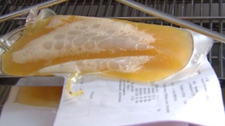 Osocze "ozdrowieńców" zawiera przeciwciała, pomagające w walce z koronawirusem.