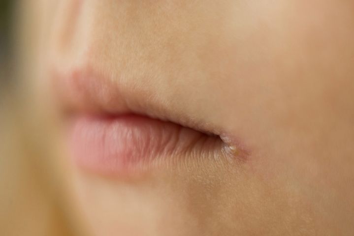 Zajady to nadżerki wywoływane przez drożdże, grzyby lub bakterie, które zlokalizowane są w kącikach ust.