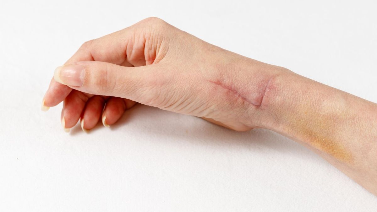 Nerw promieniowy stanowi najgrubszy nerw splotu ramiennego