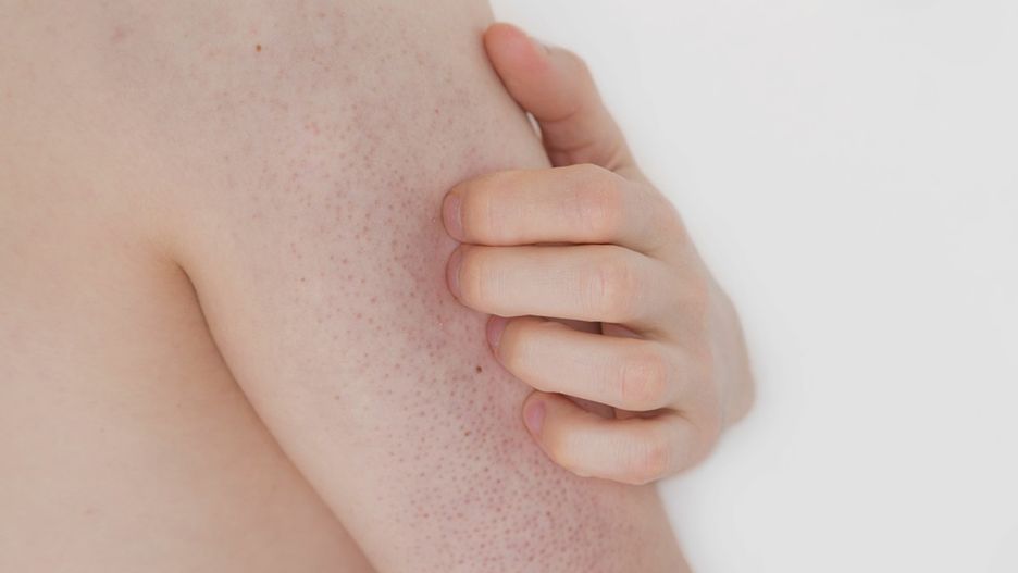 Rogowacenie mieszkowe dotyczy głównie dzieci i młodych dorosłych