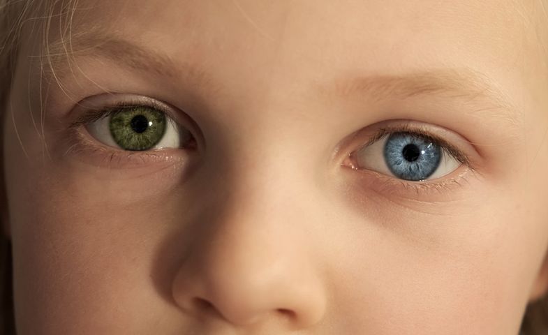 Heterochromia to niegroźna wada genetyczna, w wyniku której oczy jednego człowieka mogą mieć różną barwę