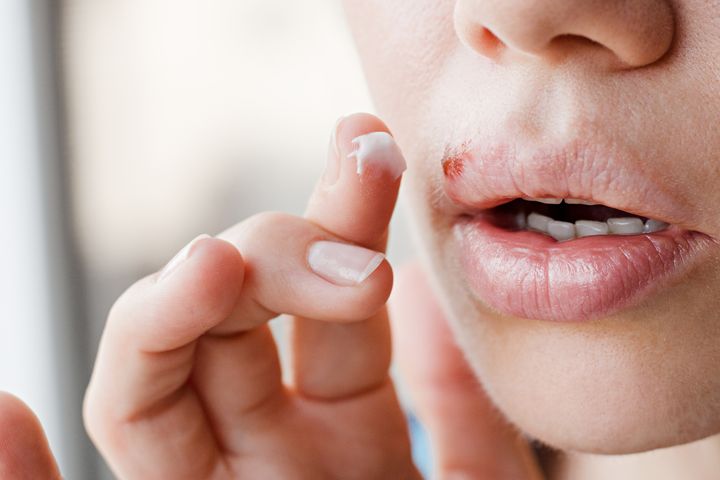 Opryszczka wargowa to nieestetyczna zmiana w okolicach ust lub nosa.