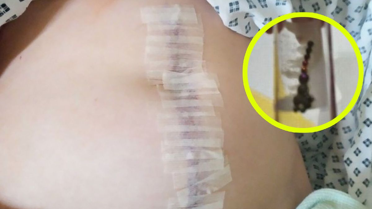 13-latka połknęła magnetyczne kulki