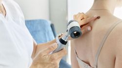 Czerniak. Sprawdź, jak samodzielnie rozpoznać zagrożenie 