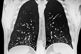 Histoplazmoza (choroba Darlinga) - objawy, przyczyny, leczenie